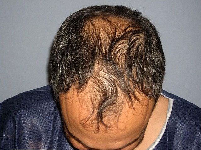 Восстановление волос на голове у мужчин