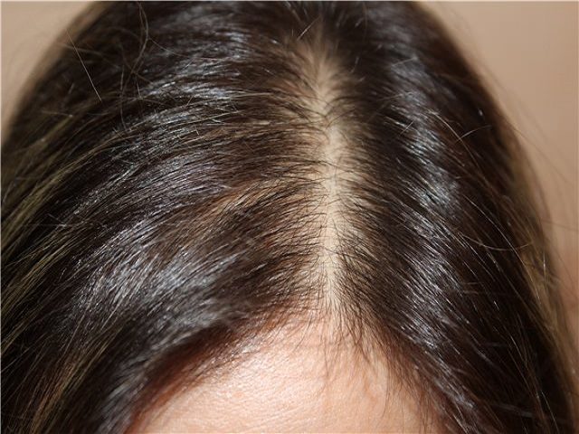 Народные средства лечения очагового выпадения волос thumbnail