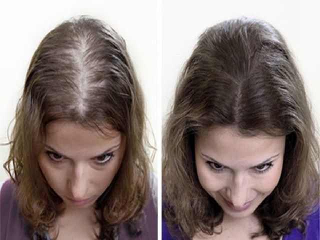 Народные средства лечения волос при облысении thumbnail