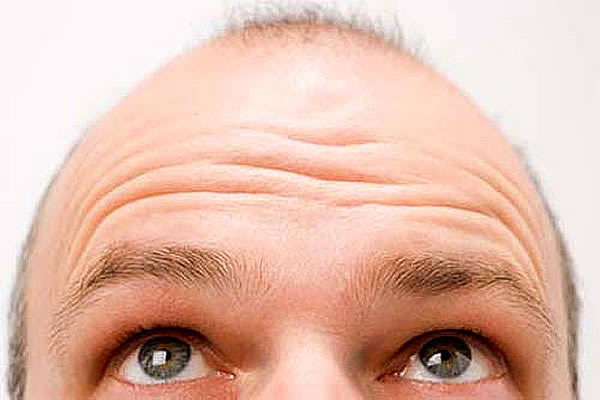 как остановить выпадение волос у мужчин резкое очаговое выпадение пятнами