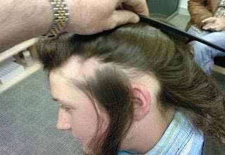 Выпадение волос на гормональном фоне лечение