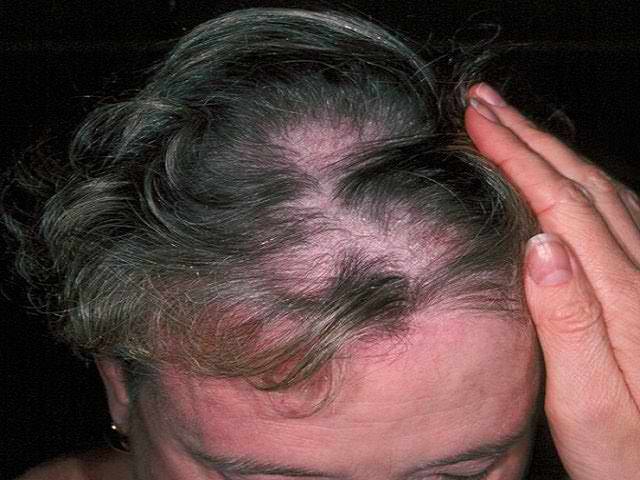 После лучевой волосы выпадают. Заболевания кожи головы.