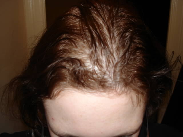 Волосы при анемии